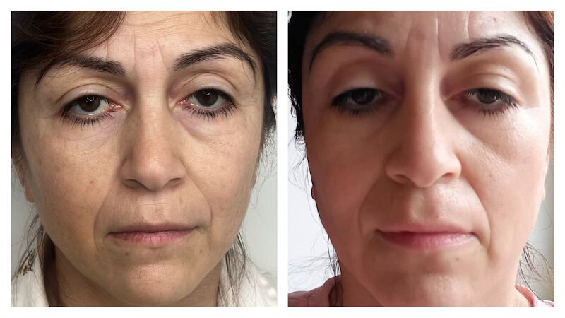 Foto van Hebe Skin Therapy | Microneedling Antwerpen